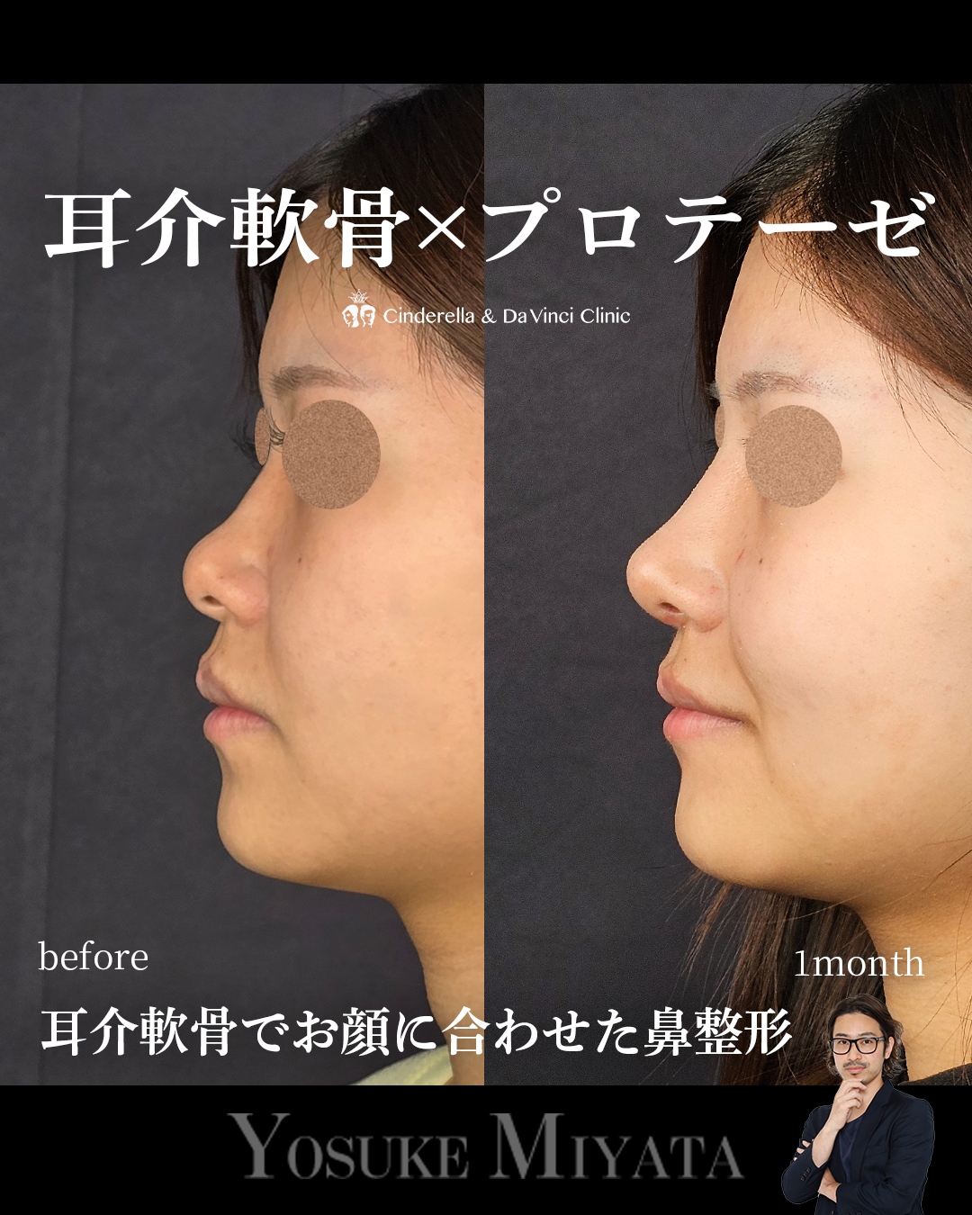 耳介軟骨×プロテーゼ