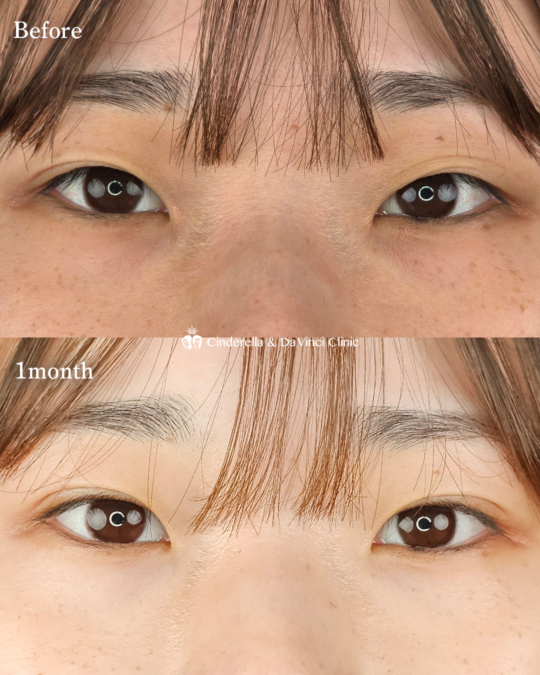 末広型の自然な二重の画像