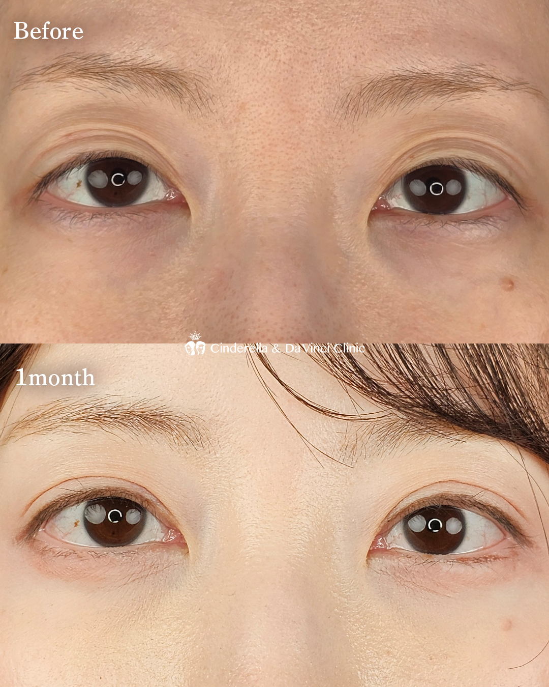 綺麗な二重の画像