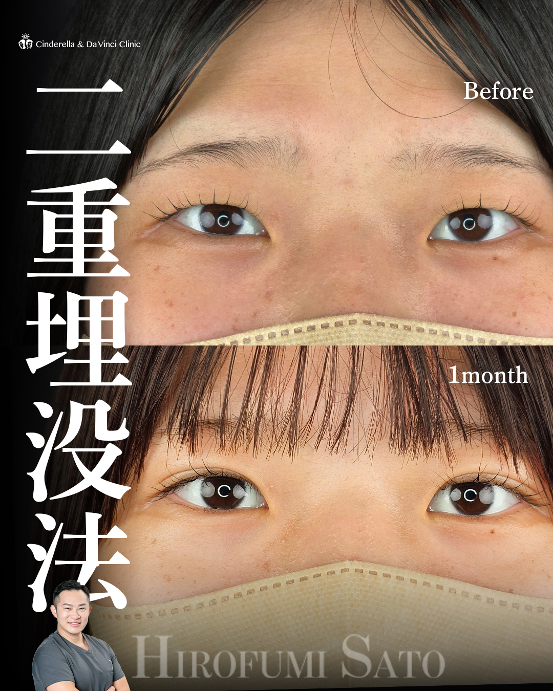 ナチュラル二重　