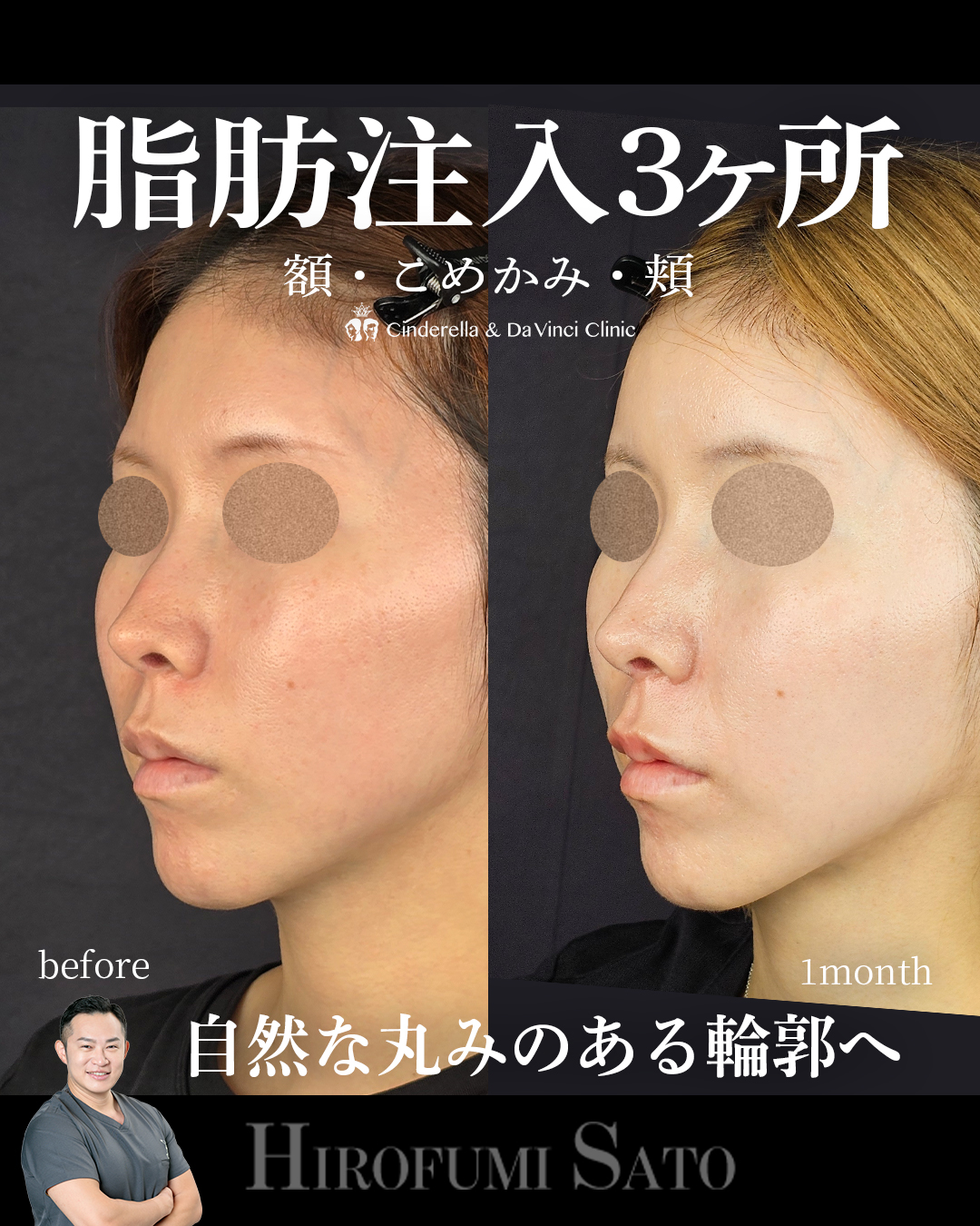 脂肪注入3ヶ所の画像