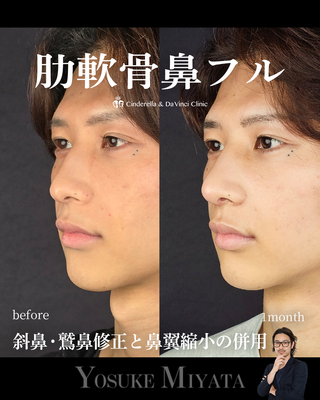 肋軟骨鼻フルの画像