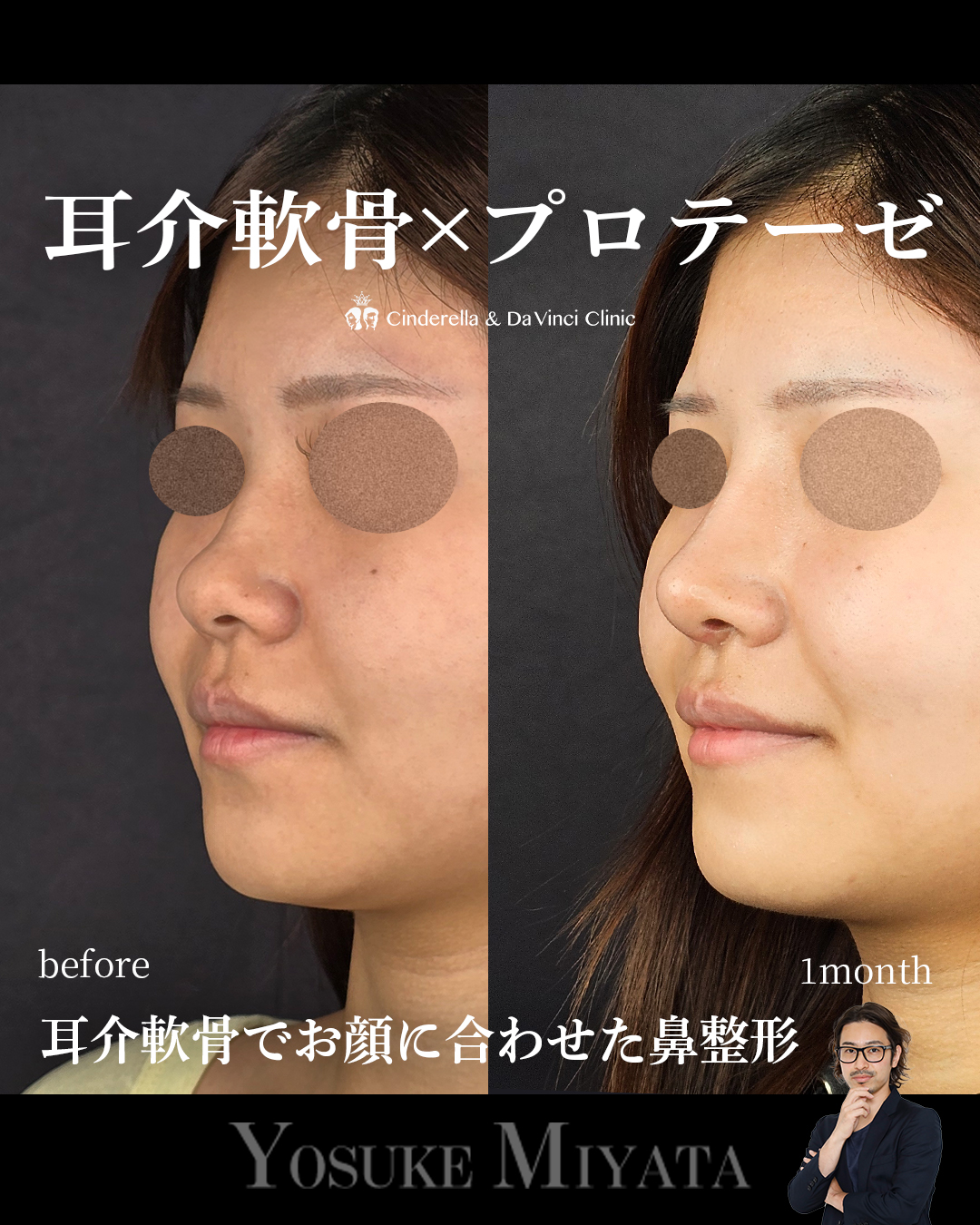 耳介軟骨×プロテーゼの画像