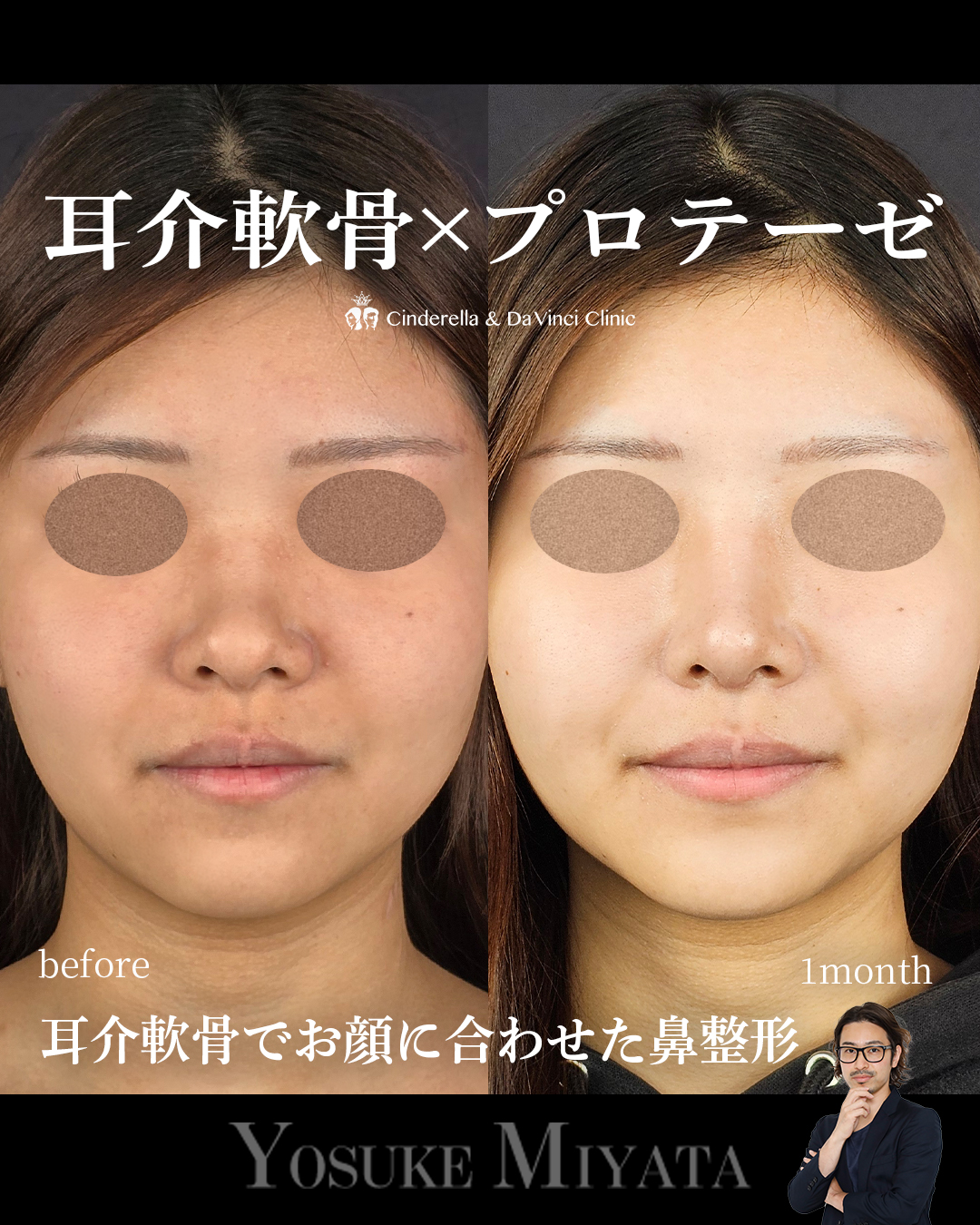 耳介軟骨×プロテーゼの画像