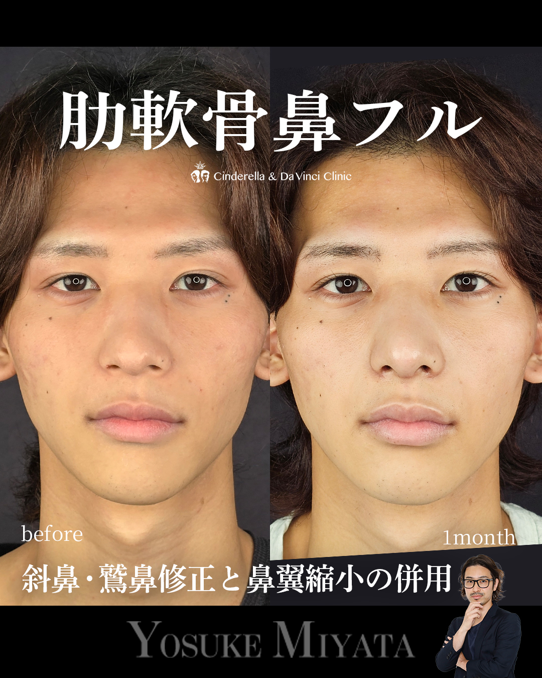 肋軟骨鼻フルの画像