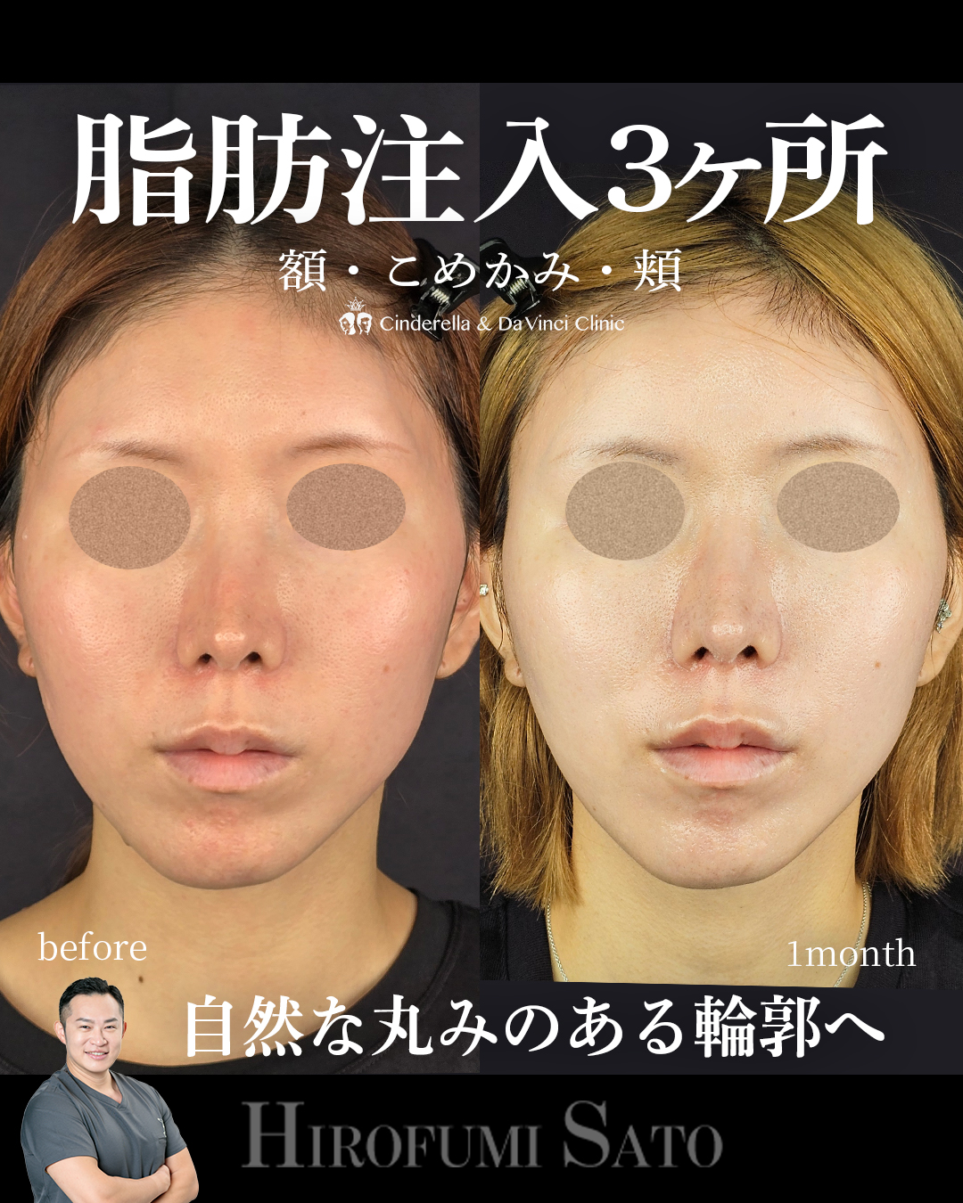 脂肪注入3ヶ所の画像