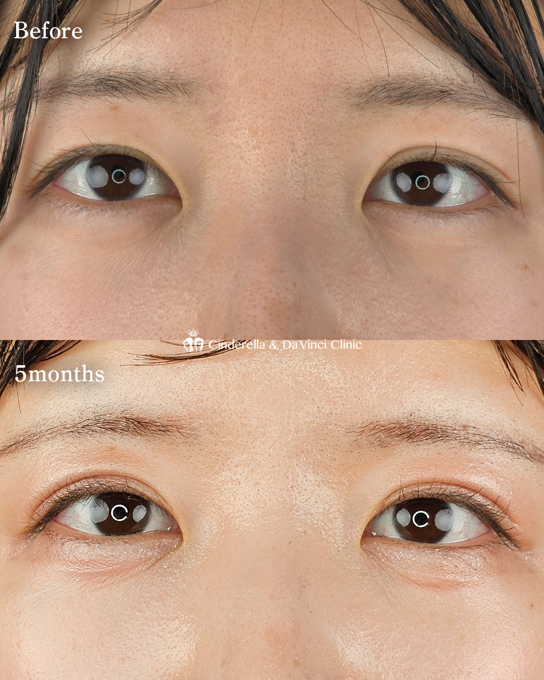 切開でつくる二重の画像