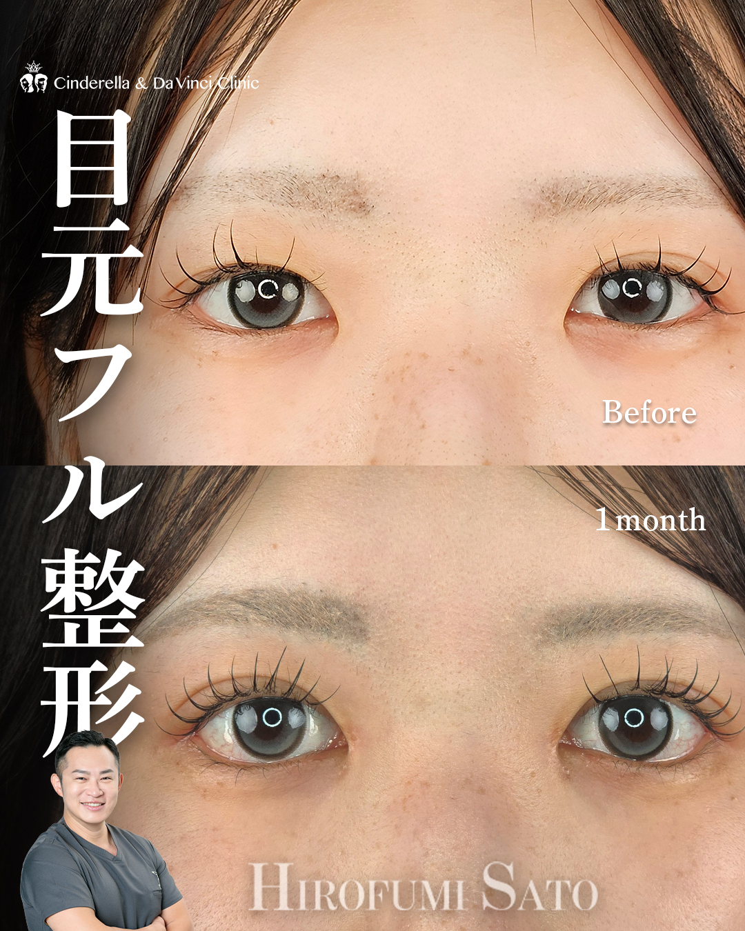 目フル整形