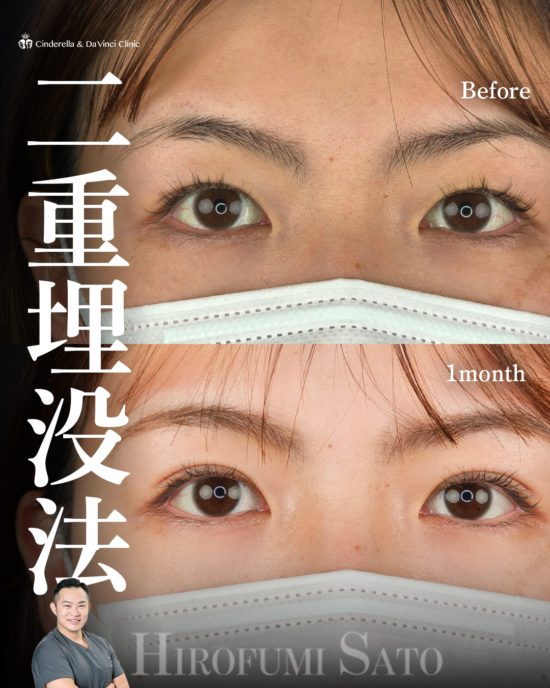 末広二重で自然に