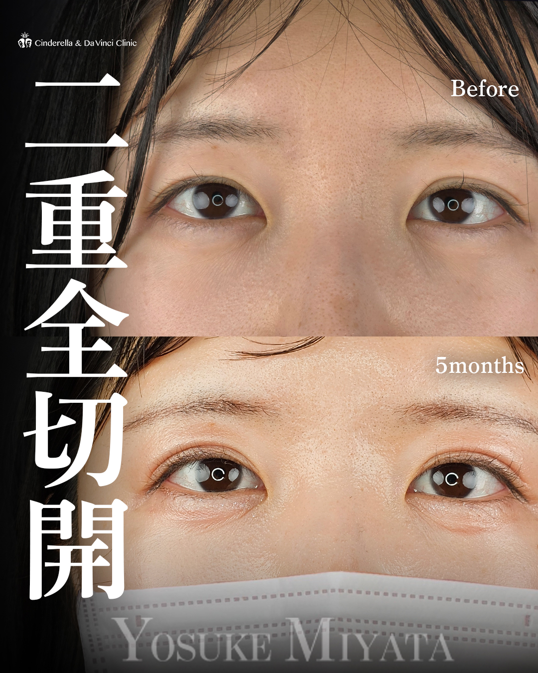 切開でつくる二重