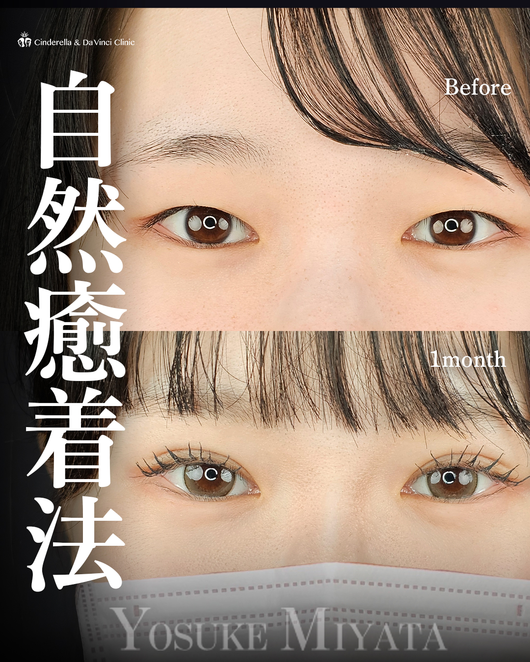 埋没でぱっちり垢抜け