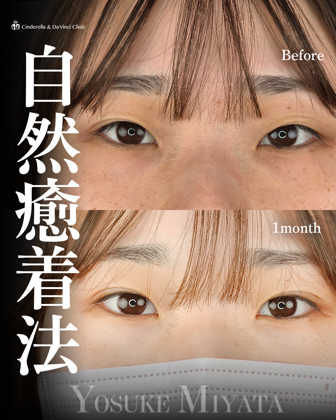 末広型の自然な二重