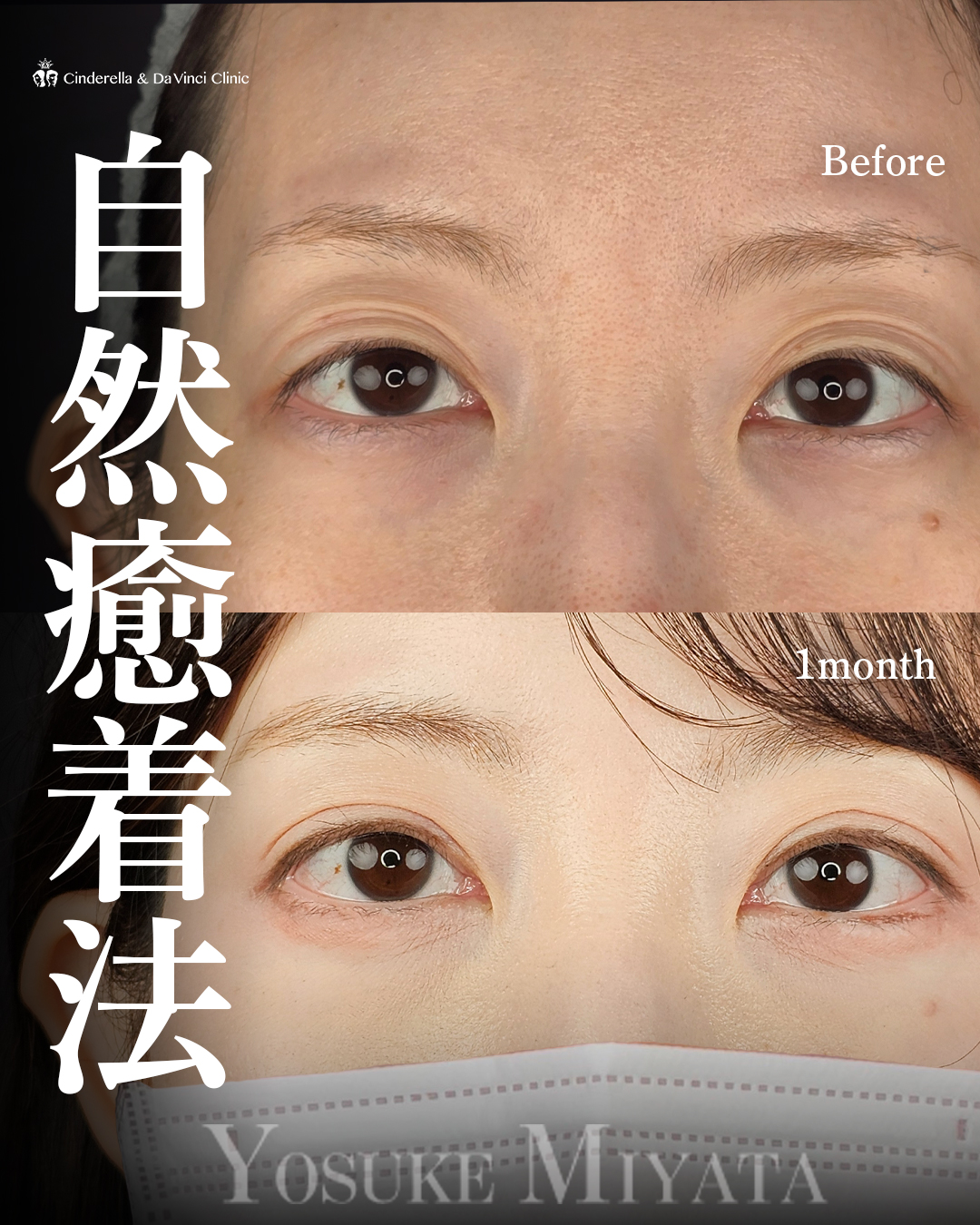 綺麗な二重