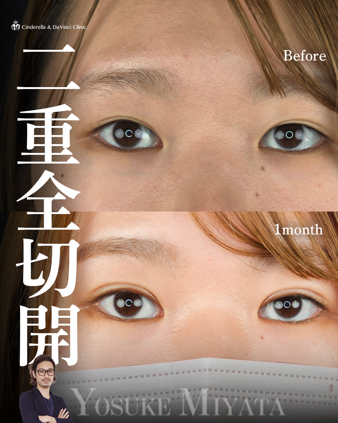 切開で自然な二重