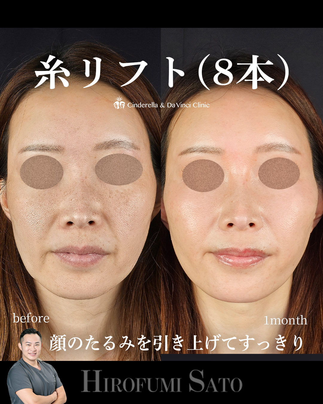 輪郭引き上げ