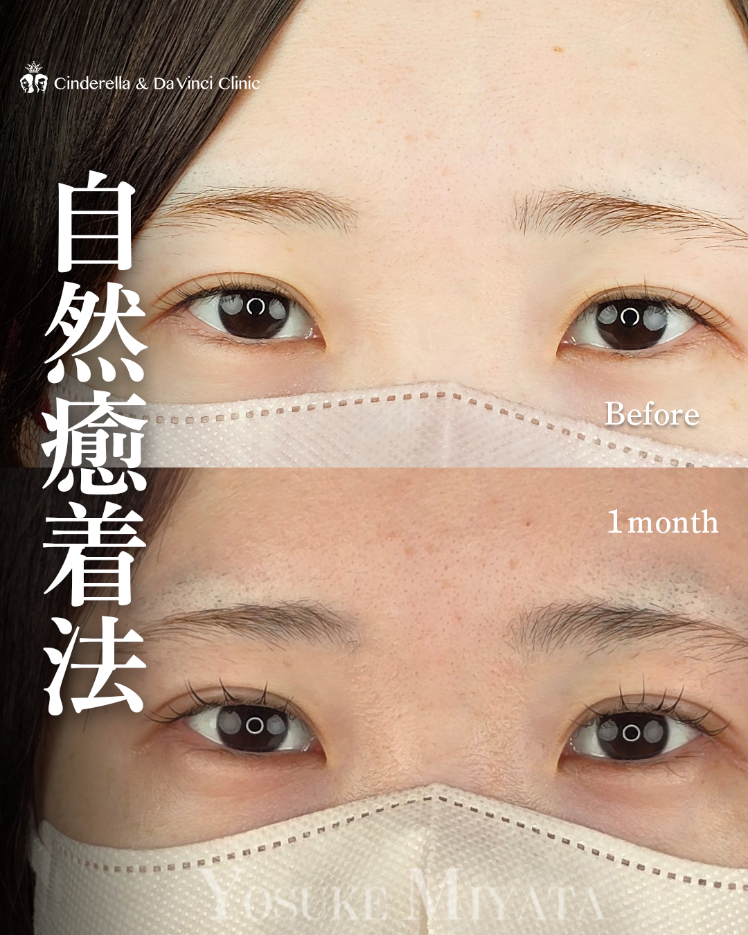二重の食い込みを埋没法で強くする