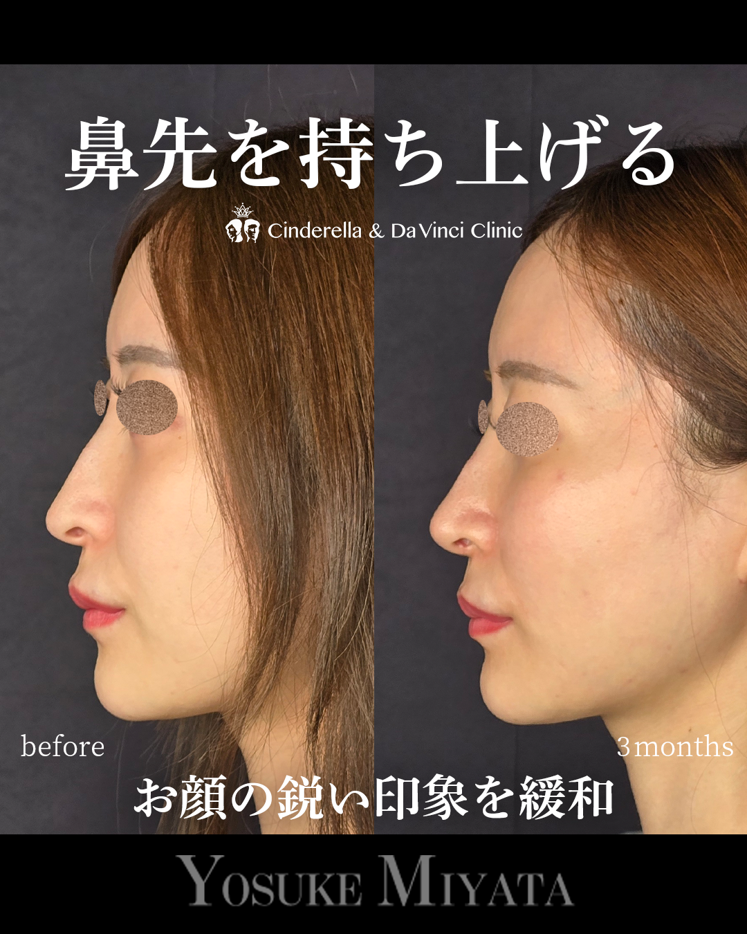 鼻先の鋭い印象と下がり感を緩和