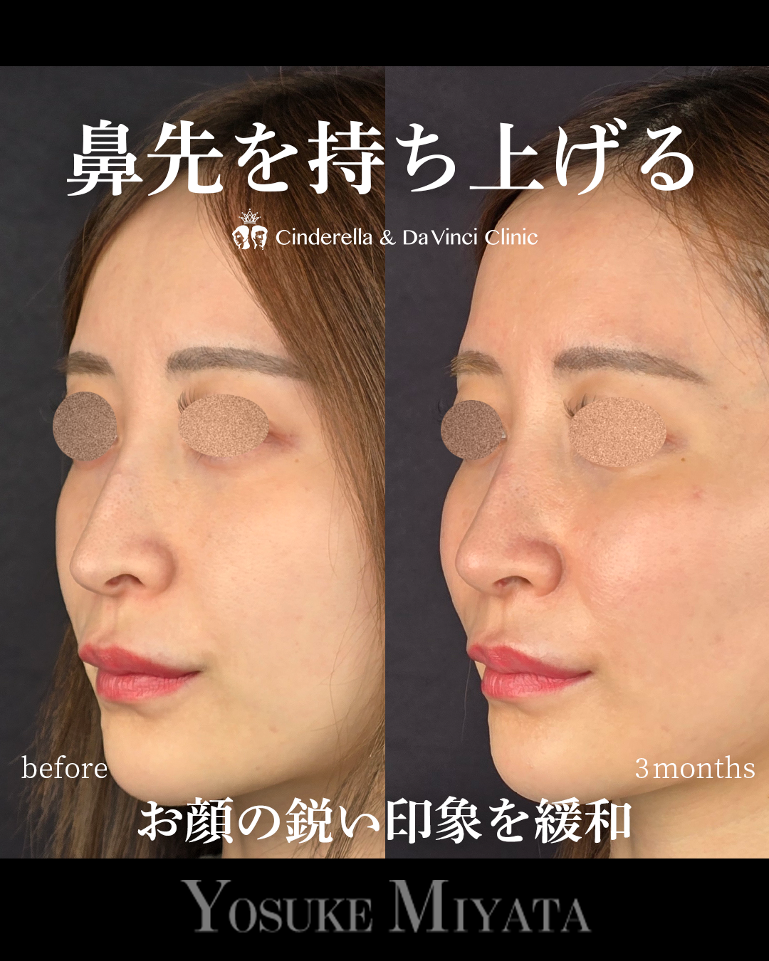 鼻先の鋭い印象と下がり感を緩和の画像
