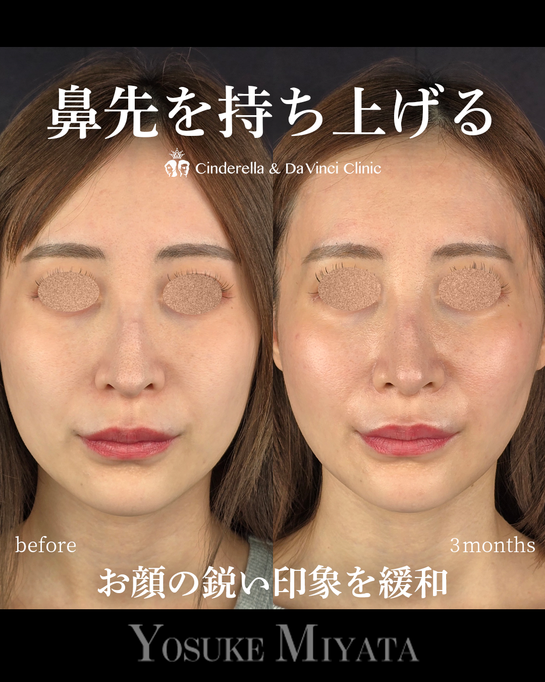 鼻先の鋭い印象と下がり感を緩和の画像