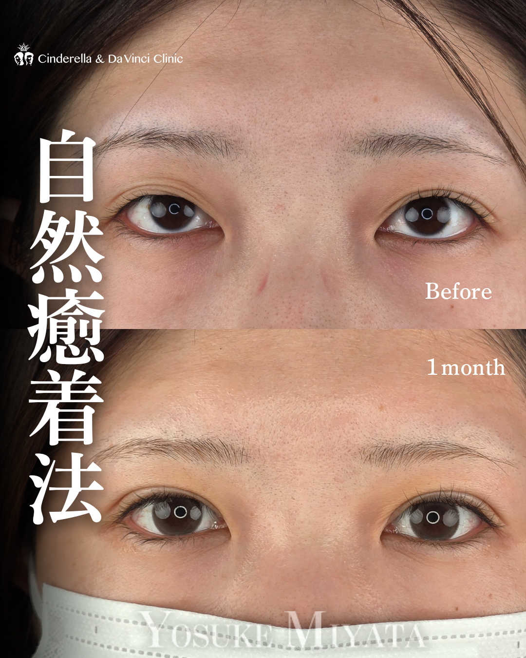 目の左右差と目つきを良く見せる