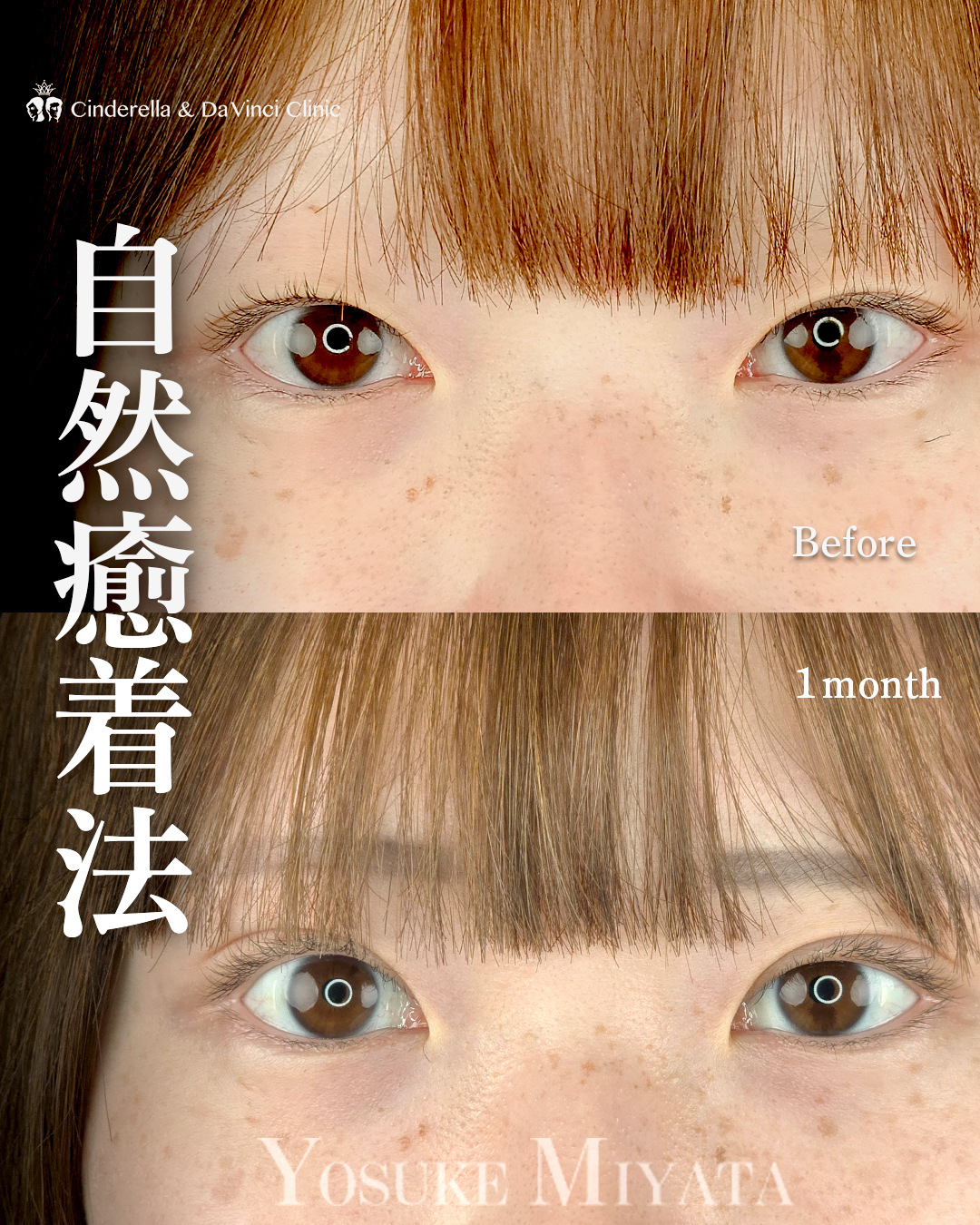 二重で目の印象をやわらかく