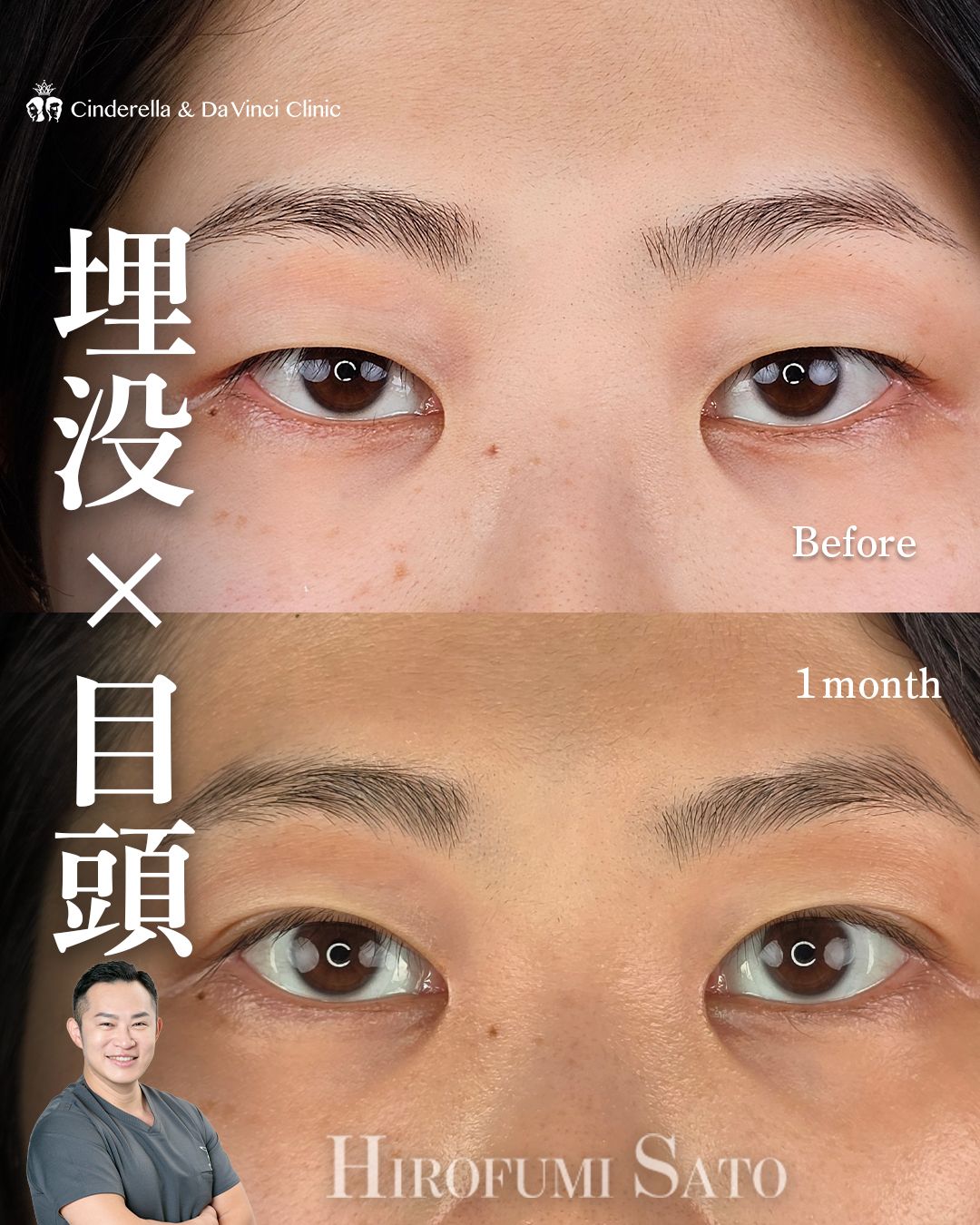 自然癒着と目頭でナチュラル変化