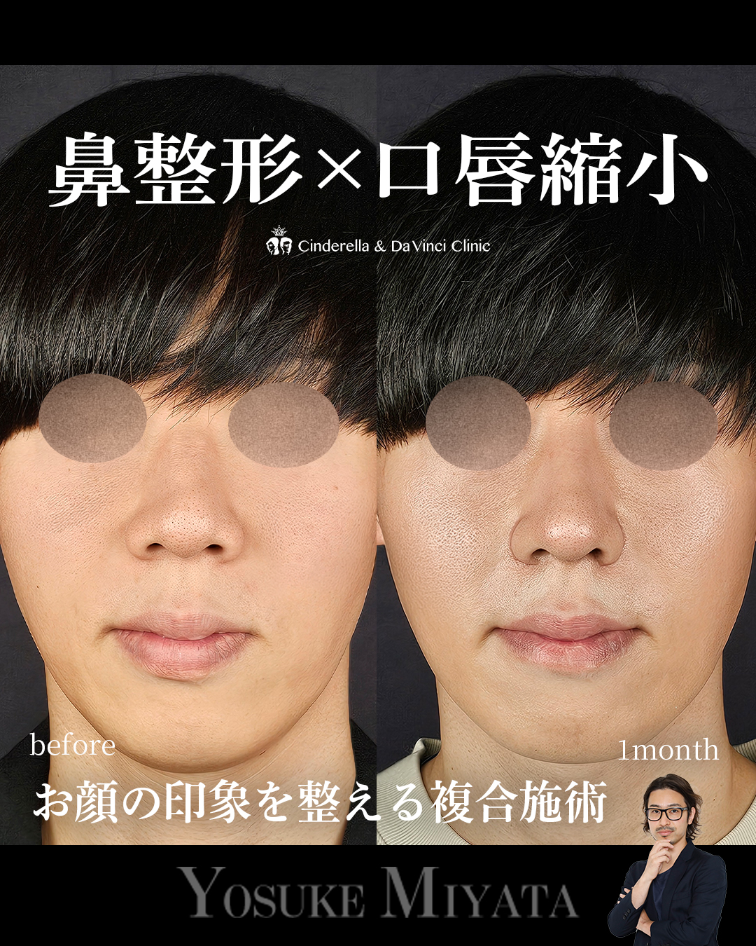鼻整形×口唇縮小