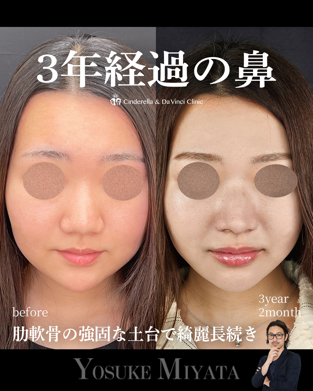 3年2ヶ月経過の鼻