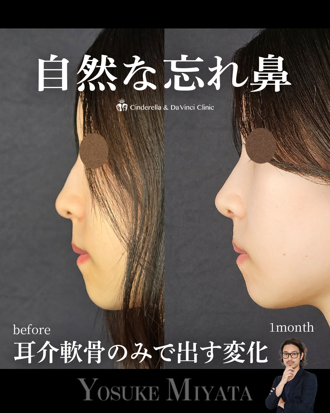 自然な鼻整形