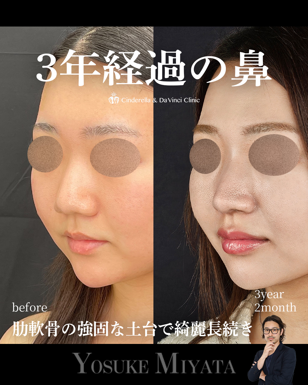 3年2ヶ月経過の鼻の画像
