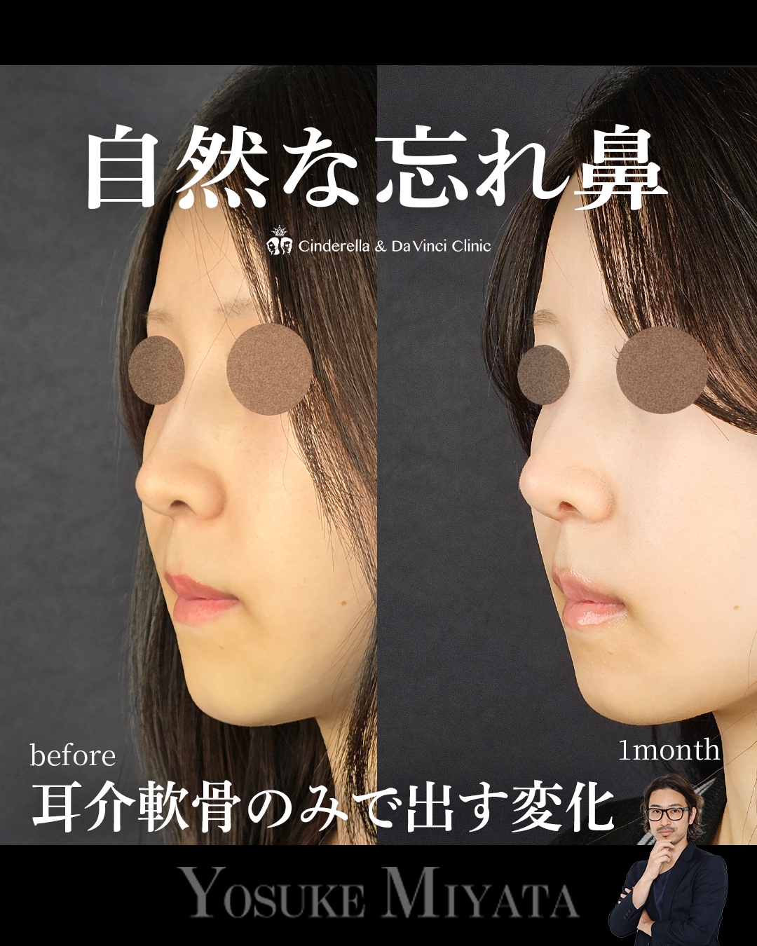 自然な鼻整形の画像