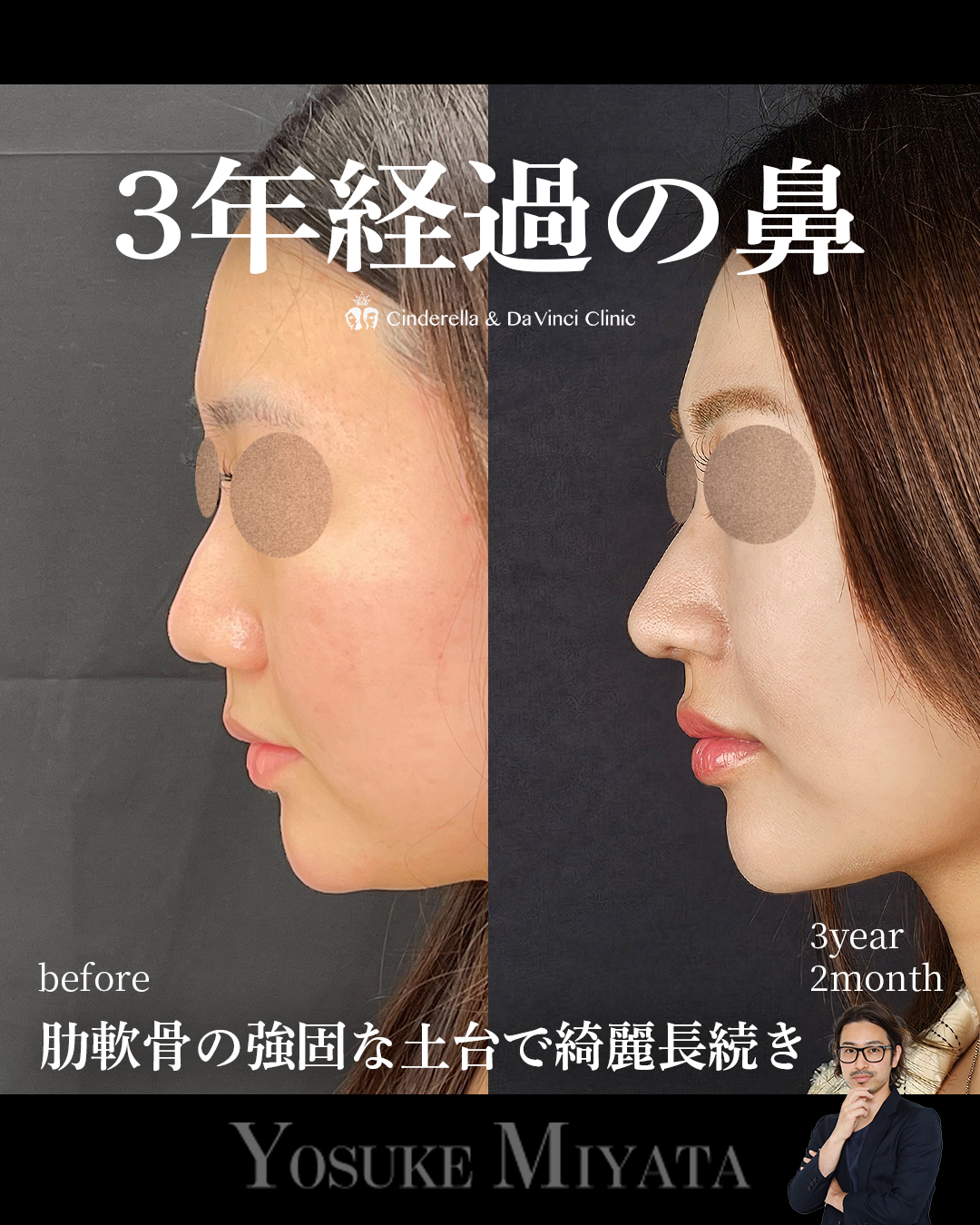3年2ヶ月経過の鼻の画像