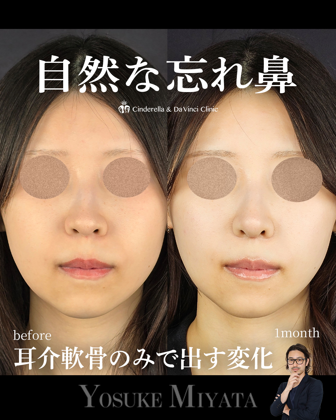 自然な鼻整形の画像
