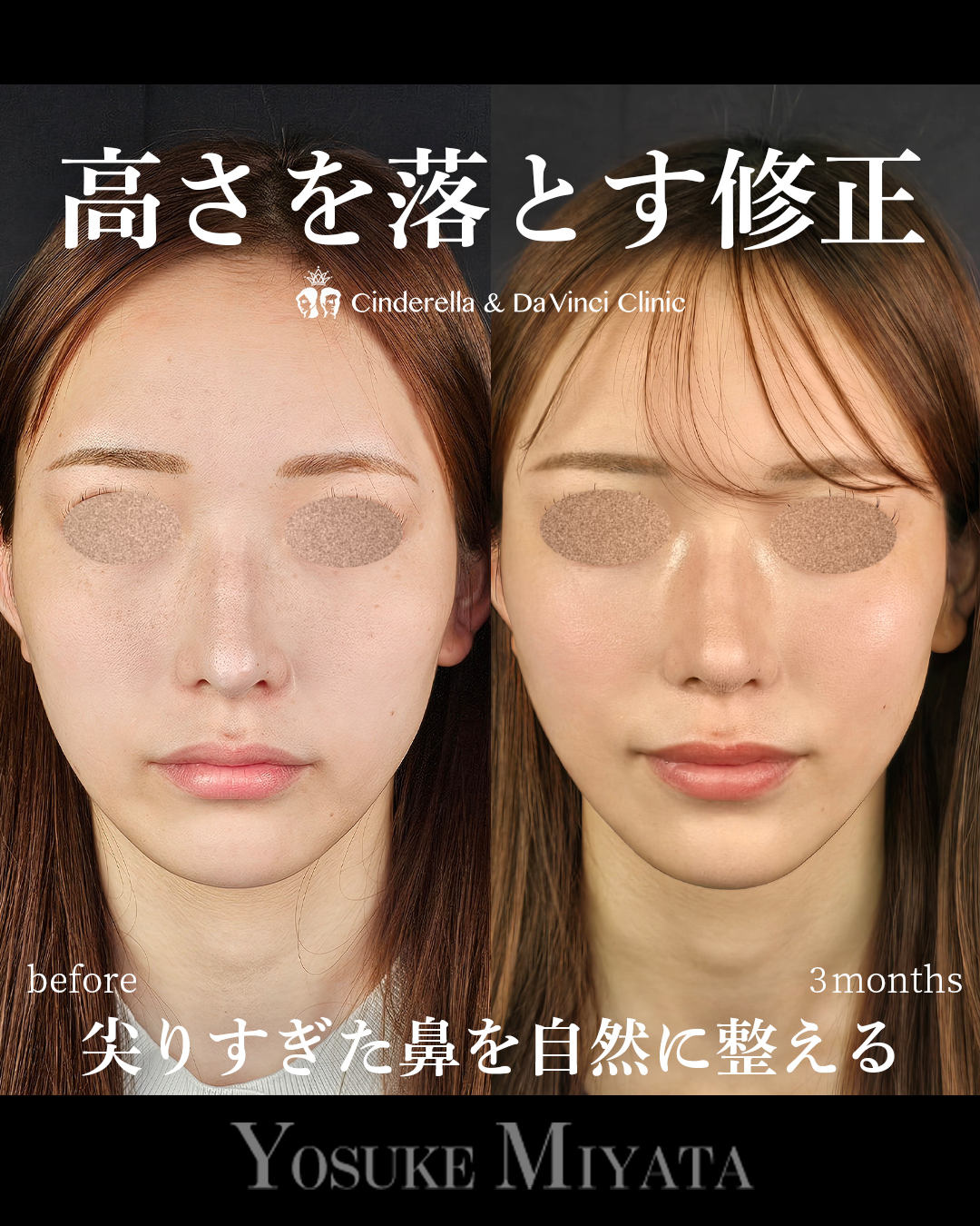 鼻の高さを落とす修正の画像