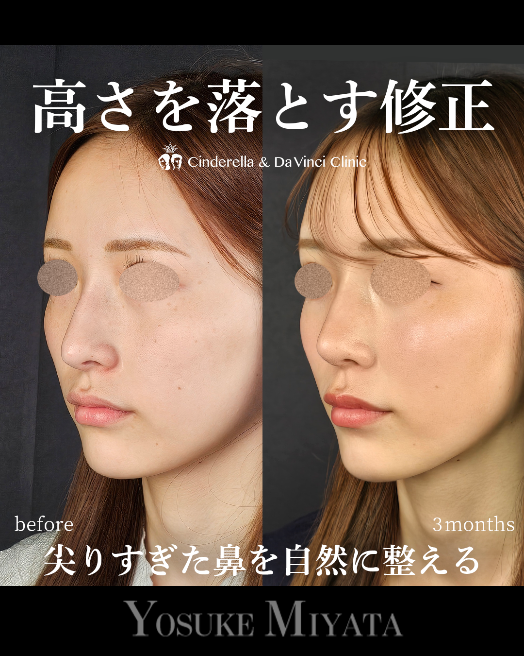 鼻の高さを落とす修正の画像