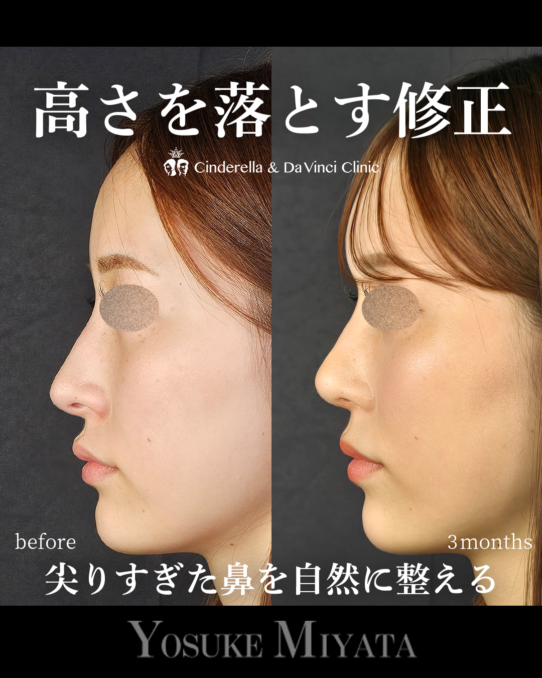 鼻の高さを落とす修正