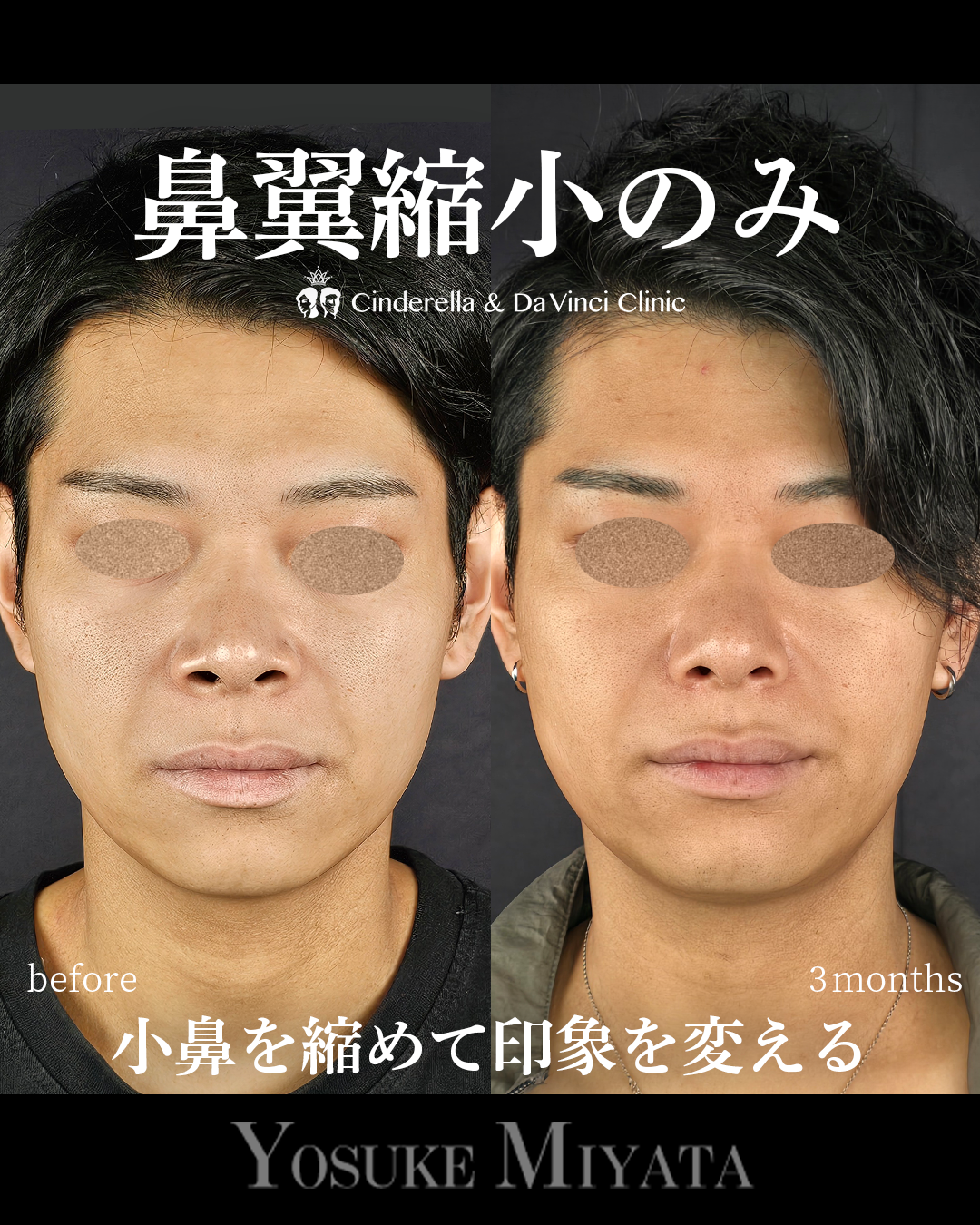 小鼻縮小のみの手術