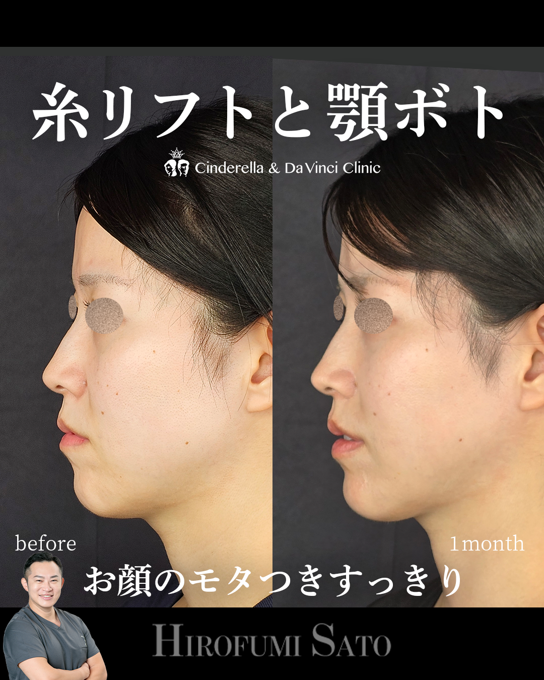 糸リフトで顔のモタつきすっきり