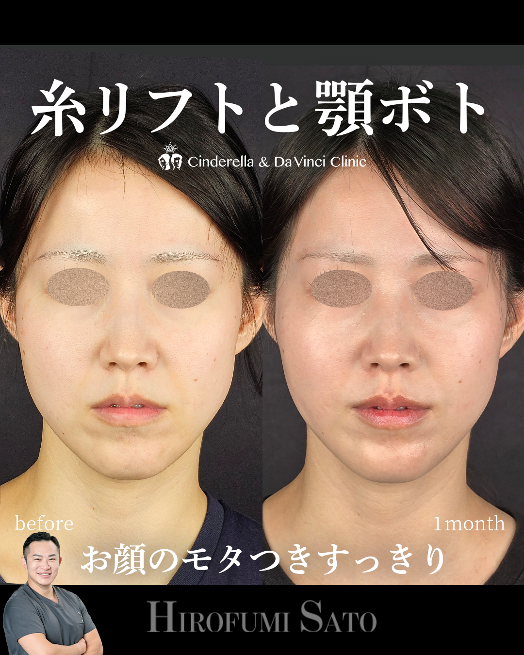 糸リフトで顔のモタつきすっきりの画像