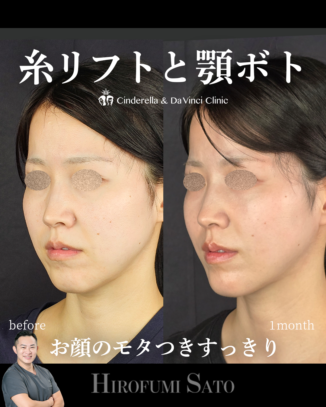 糸リフトで顔のモタつきすっきりの画像