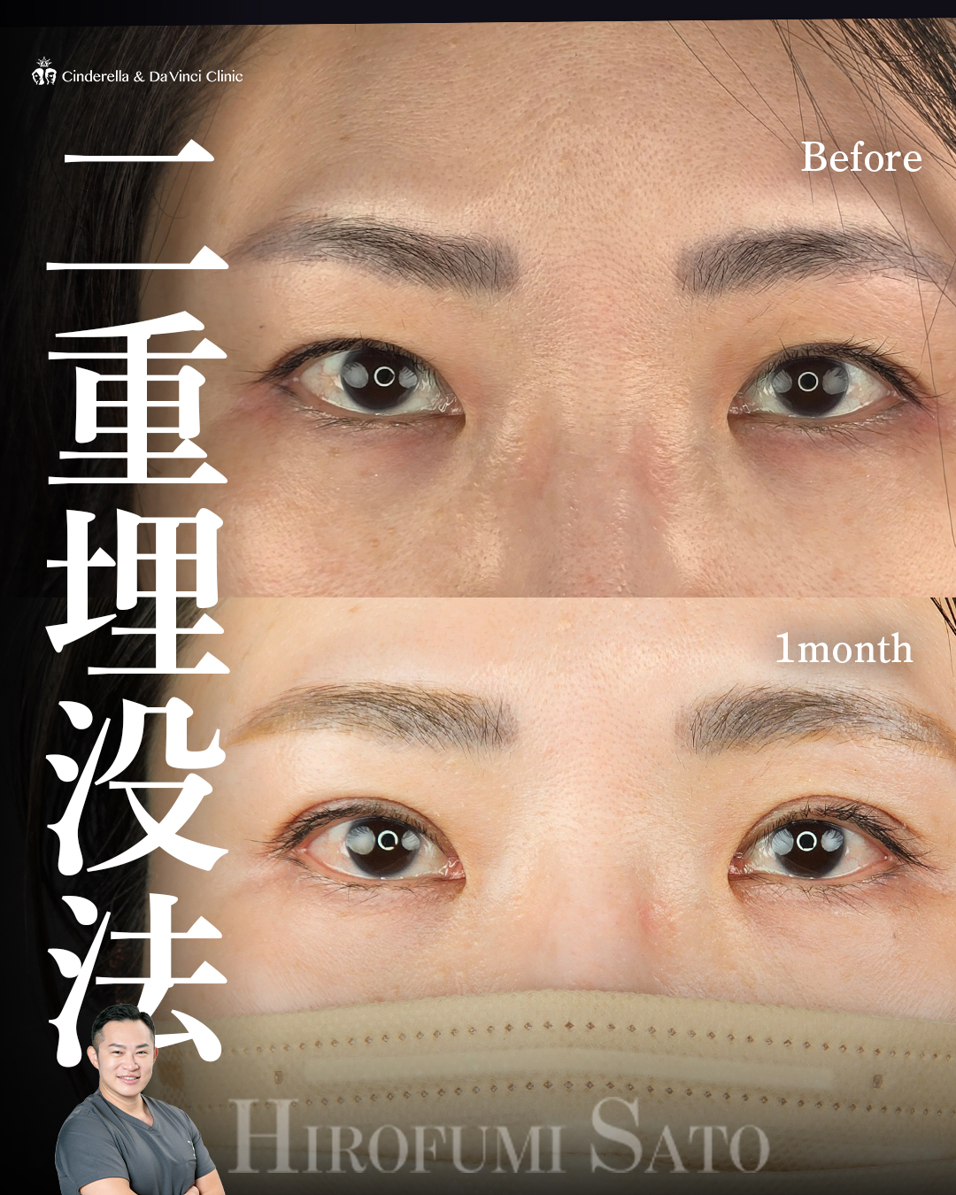 幅を少し広げて左右差を整る