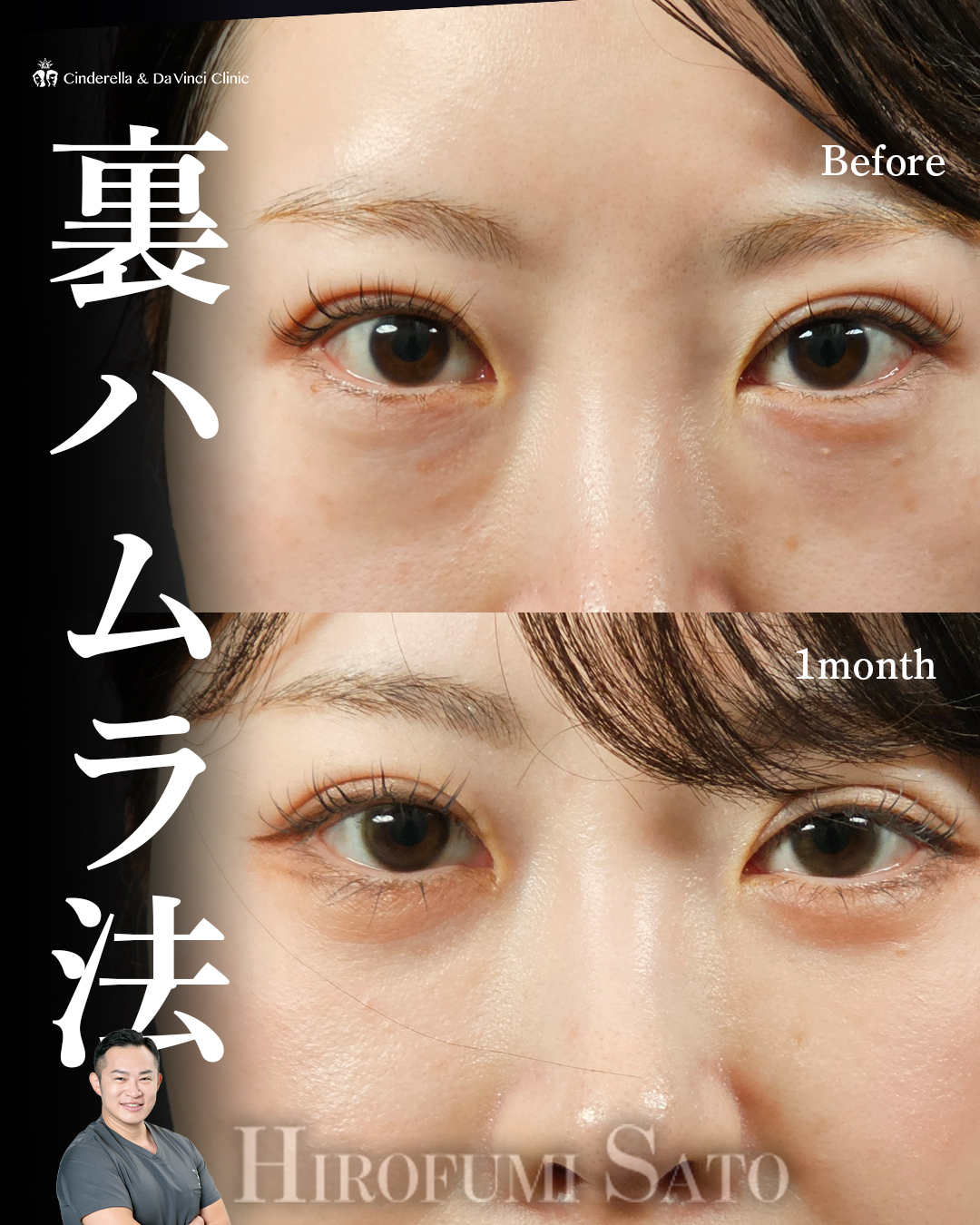 クマ取りで目元明るく