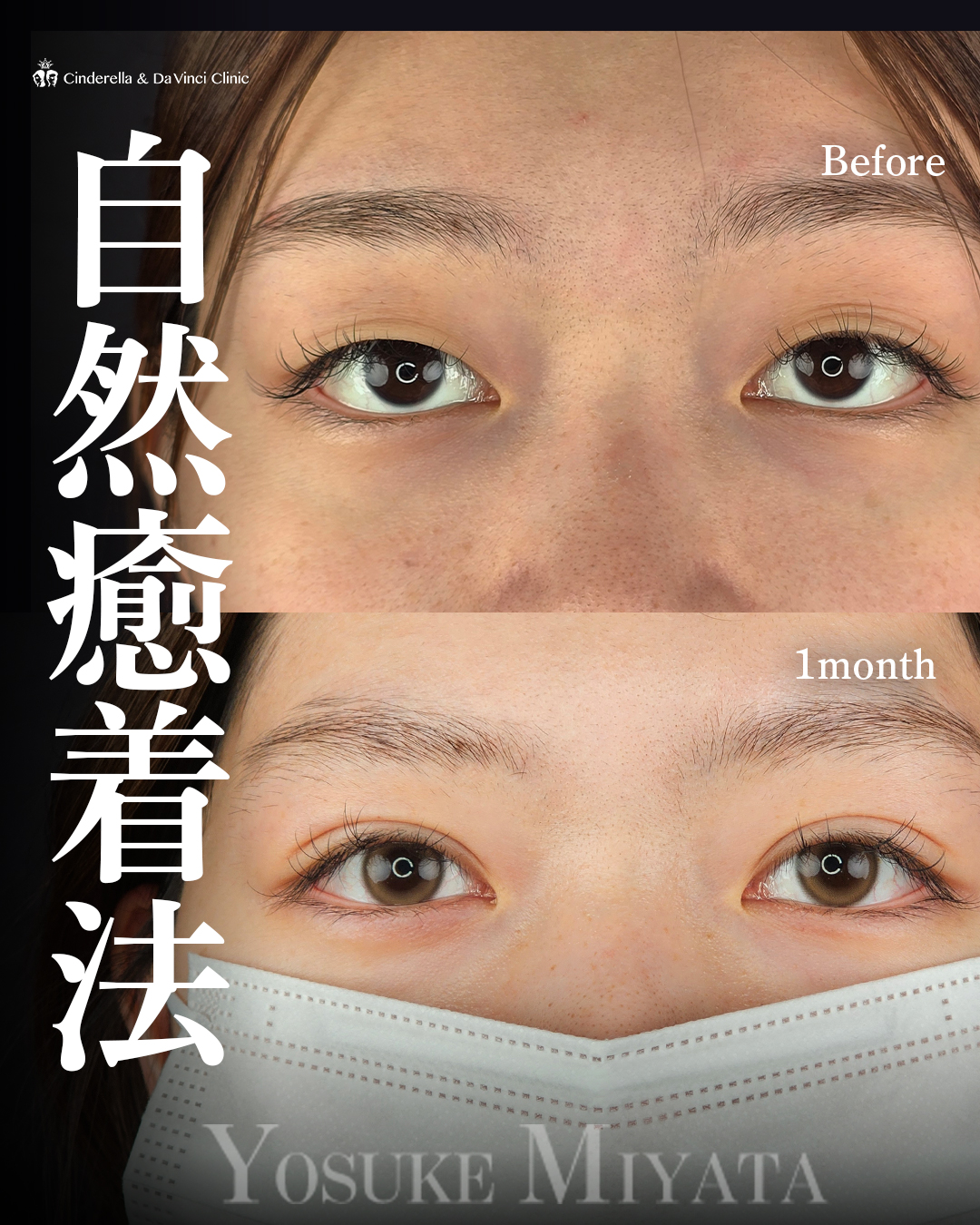 一重から二重へ